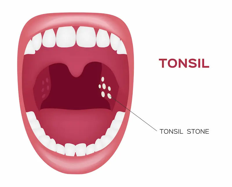 How To Remove Tonsil Stones Best Popular Remedies